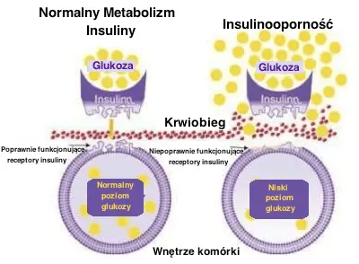 insulinooporność